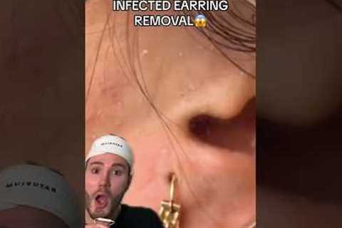 INFECTED EARRING REMOVAL!😱 (follow for more💗) #beauty #skincare #beautytips #acne #skincareroutine