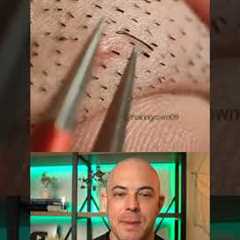 Derm reacts to stubborn ingrown hair removal! #dermreacts #doctorreacts #ingrownhair