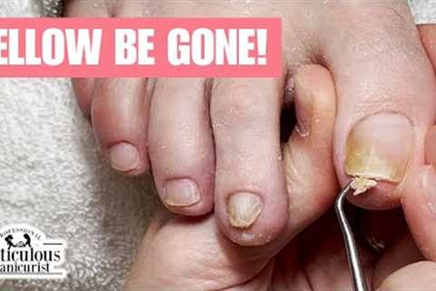 Why Are My Toenails Turning Yellow? #nails #satisfying